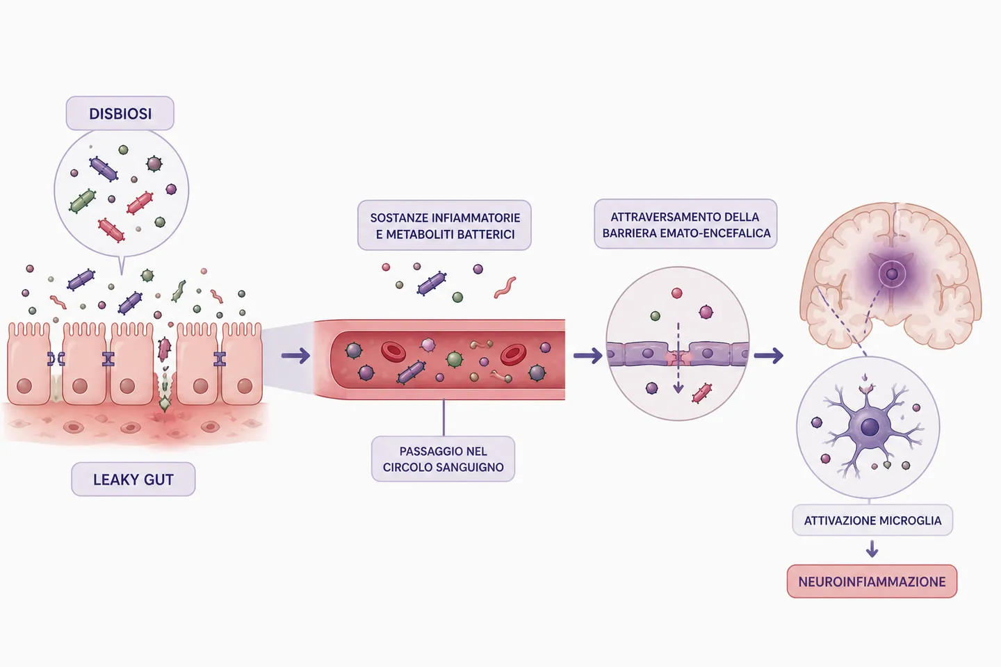 Schema del passaggio dalla disbiosi e dal leaky gut all’infiammazione, con le sostanze che attraversano la barriera emato-encefalica e attivano la microglia, fino alla neuroinfiammazione
